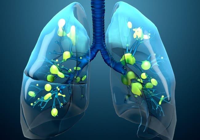 Sindromul de detresa respiratorie acuta (SDRA): origini, manifestari si optiuni terapeutice